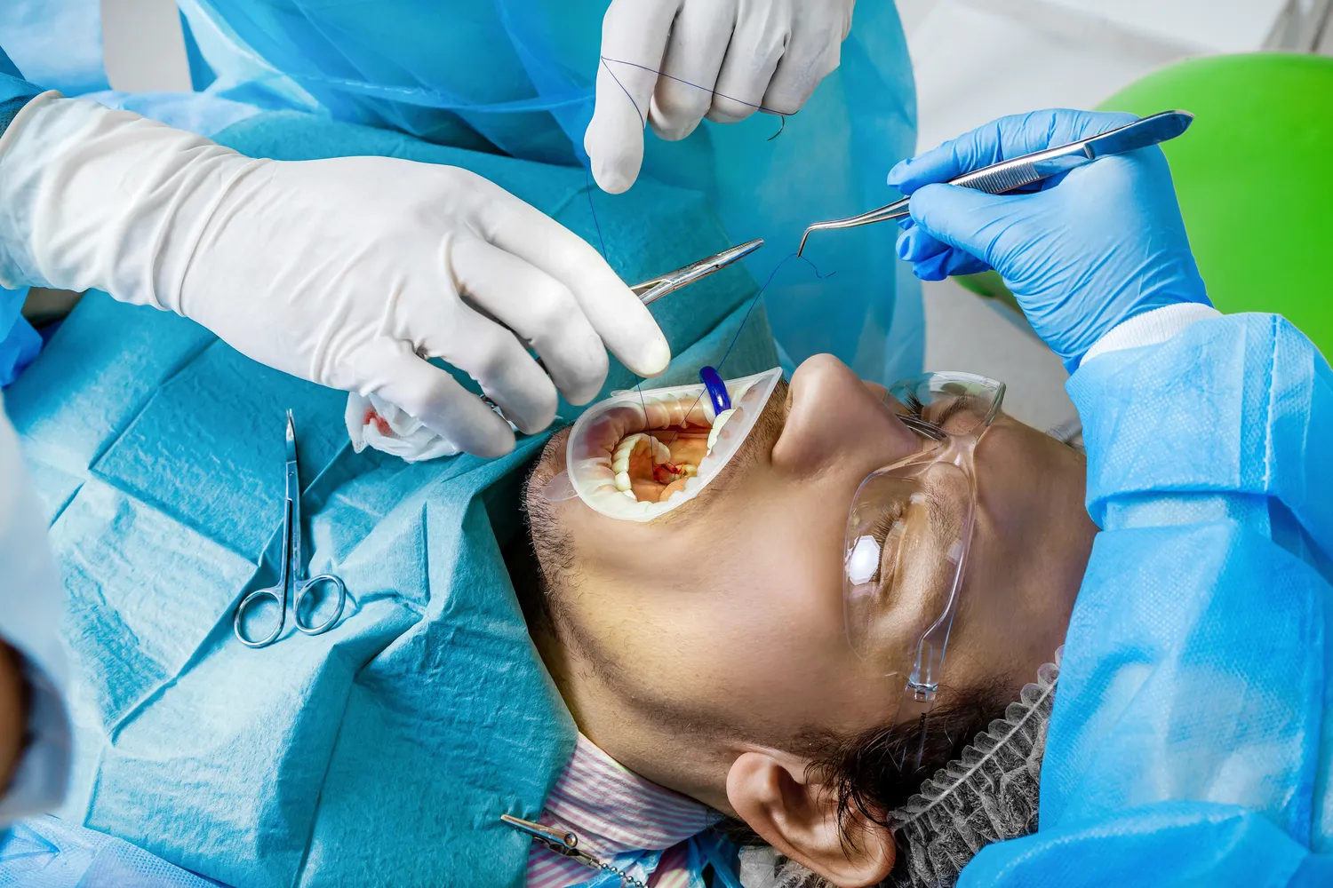 Na czym polega leczenie kanałowe zęba?