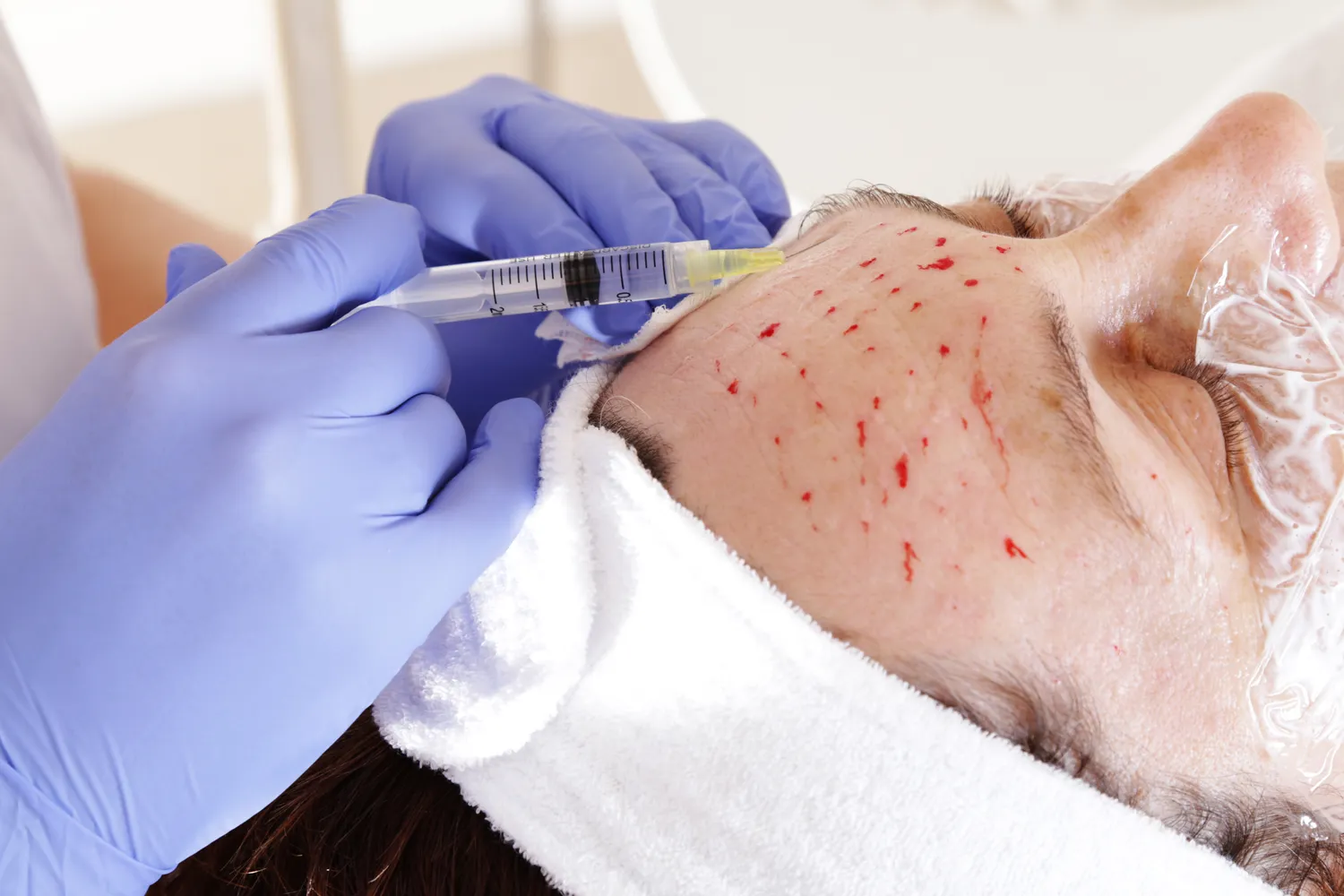 Jak zlikwidować worki pod oczami medycyna estetyczna?